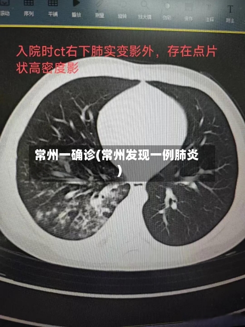 常州一确诊(常州发现一例肺炎)-第2张图片