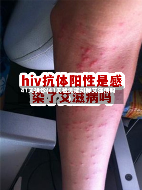 41天确诊(41天检测能排除艾滋病吗)-第2张图片